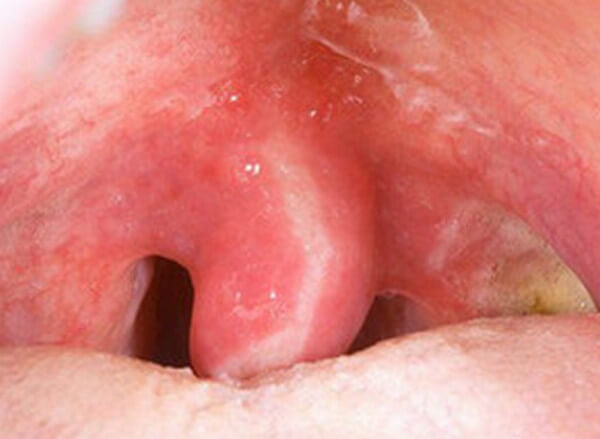 Swelling Of Throat 29