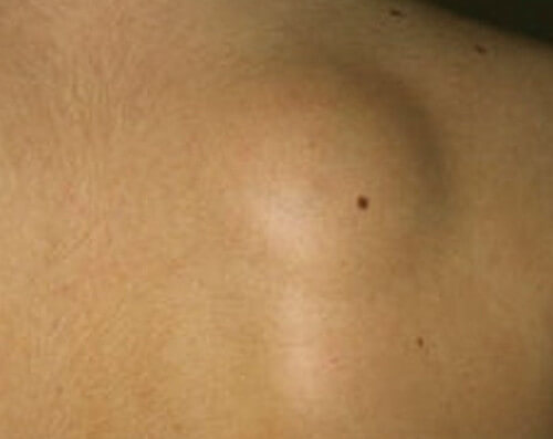 Lipoma Symptoms Pictures Causes Removal Surgery Treatment