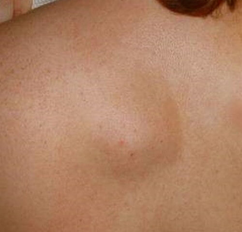 Lipoma Causes, Symptoms, Treatments, and More - WebMD