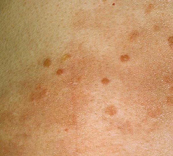 Hiv Rash Symptoms Pics And Treatment Hot Sex Picture