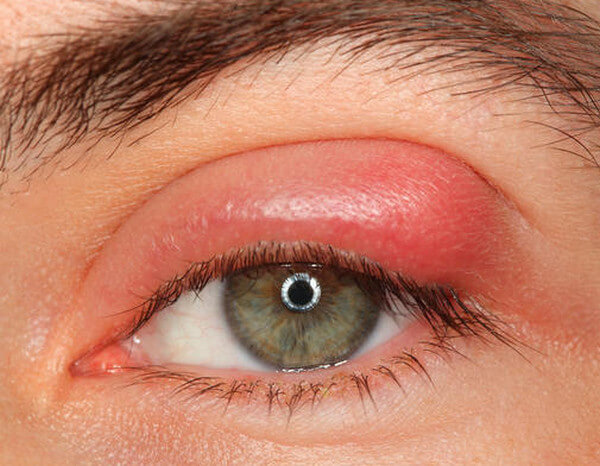 What Causes Swollen Eyelids And Red Eyes