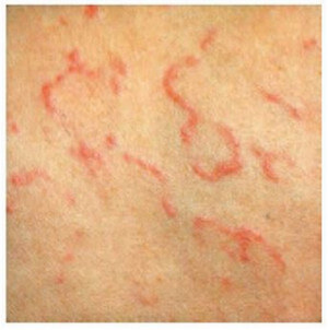 Erythema Multiforme - Pictures, Treatment, Symptoms, Causes