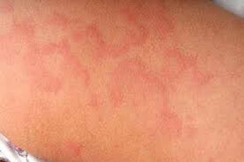 Rash On Palms And Soles Pictures