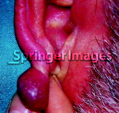 angiolipoleiomyoma Lipoma picture