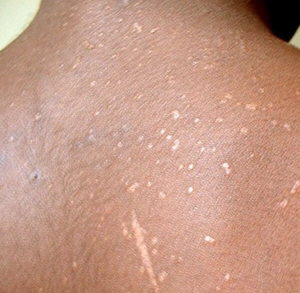 Hiv Rash - Symptoms, Pics And Treatment - 2020 - Updated-8408