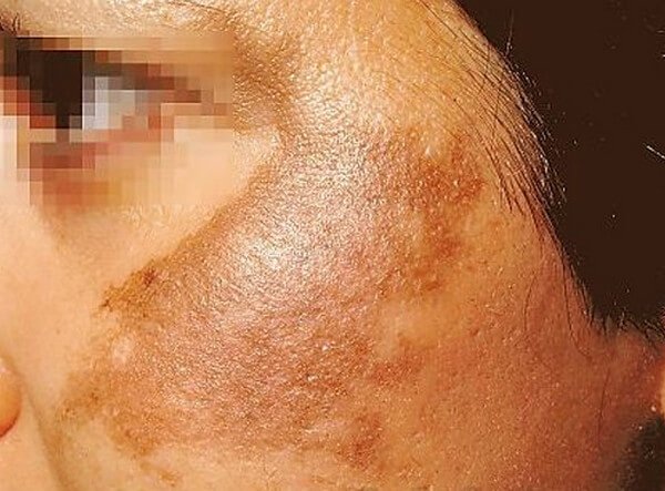 melasma on cheek picture