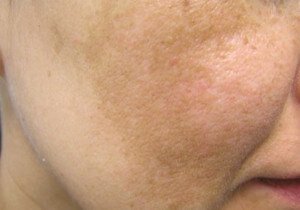 Melasma (Chloasma) - Pictures, Causes, Symptoms and Treatment