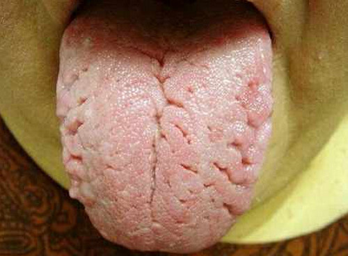 Fissured Tongue photo