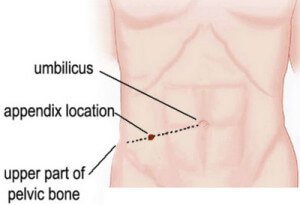 Appendix Rupture Pain Region Appendix Pain - Location (Pictures), Symptoms, Causes, Treatment