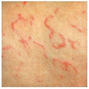 Erythema Marginatum - Pictures, Symptoms and Treatment