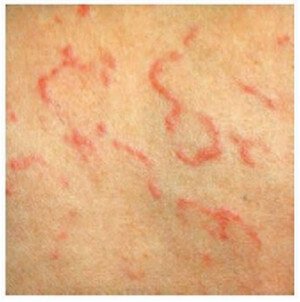 Erythema Marginatum of Rheumatic Fever photo