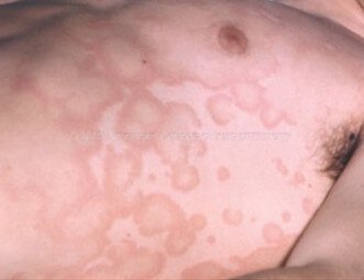 Erythema marginatum picture