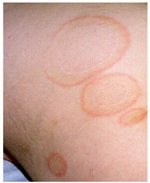 Erythema marginatum Image