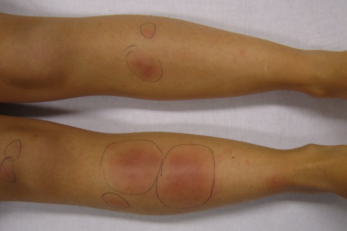 Panniculitis - Definition, Pictures, Symptoms, Causes 