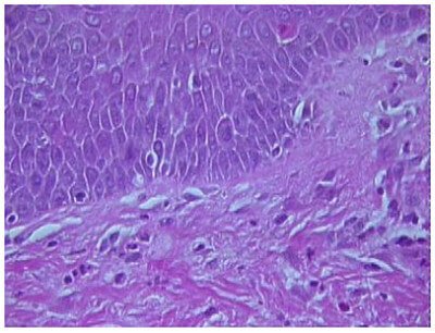 Histologic Features of Erythema Marginatum