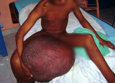 Lymphatic Filariasis Pictures 4