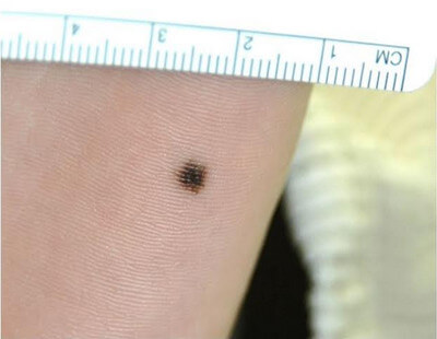 Macule measures less than 1 cm. It is a flat blemish like that of a freckle picture