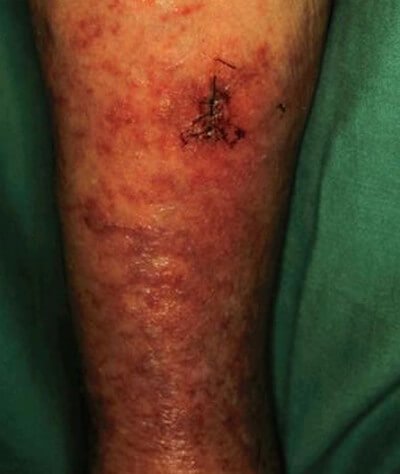 Pancreatic panniculitis in a woman with acute pancreatitis picture