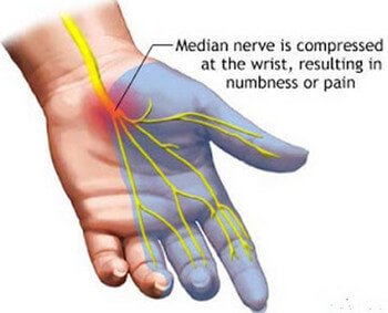 Paresthesia caused by Carpal Tunnel syndrome