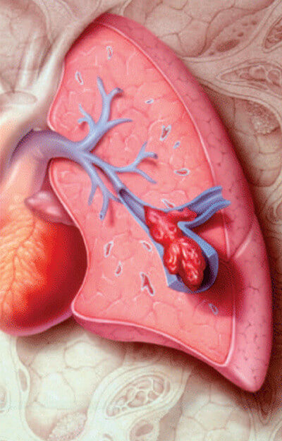 Pulmonary embolism photo
