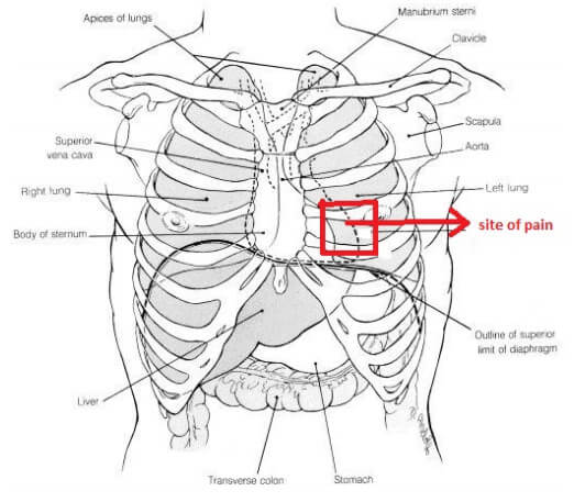 Site of pain in Precordial catch syndrome picture