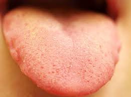 taste buds inflamed bud enlarged swollen treatment