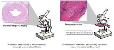 temporal arteritis-biopsy
