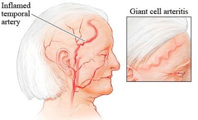 temporal arteritis-inflammed temporal artery