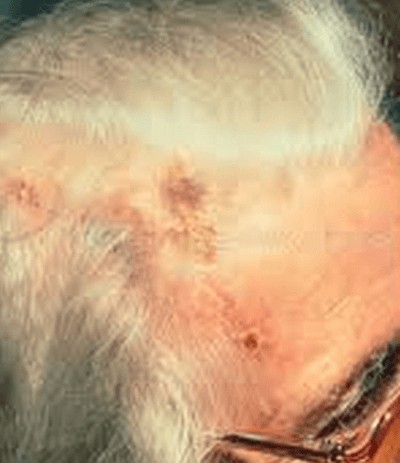 temporal arteritis-scalp necrosis