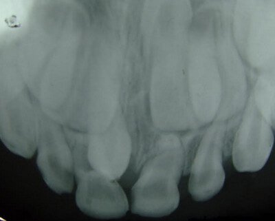 17+ Supernumerary Teeth Chart