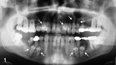 Multiple Supernumerary Teeth on Orthopantomograph image