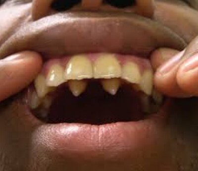 Supernumerary teeth behind the central incisors picture