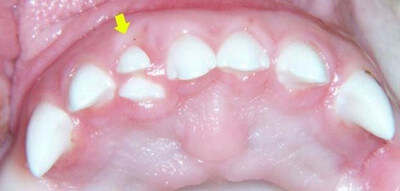 Supernumerary teeth on lateral incisors image