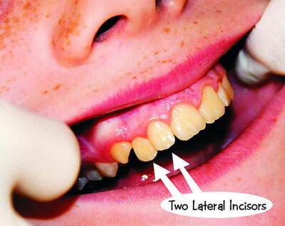 Supplemental Supernumerary Tooth image