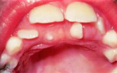 Tuberculate Supernumerary Teeth picture