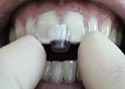 mouth splints picture