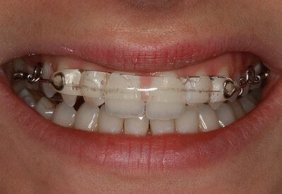 teeth aligner image