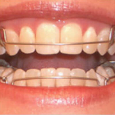 teeth retainers photo