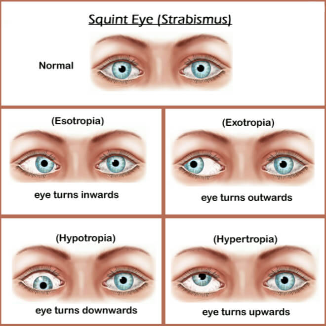Different types of strabismus