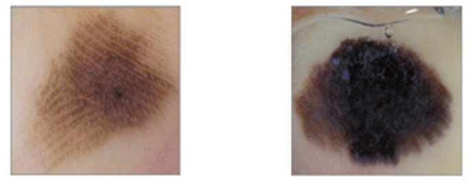 PRP, PFP or fibrillary pattern Acral lentiginous melanoma