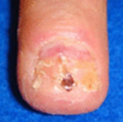 Subungual melanoma photo nail