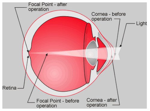 The eye after LASIK surgery