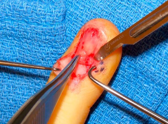 demonstrates nail and tissue removal process melanoma