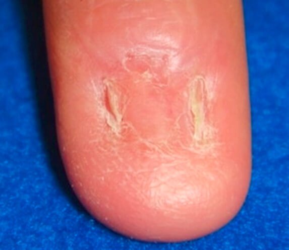 finger after the aforementioned nail lesion removal subungual melanoma and skin graft placement