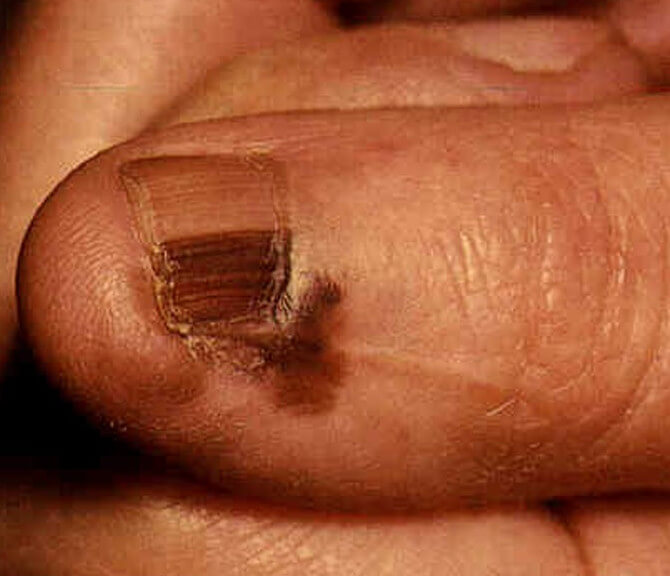 nail acral lentiginous melanoma