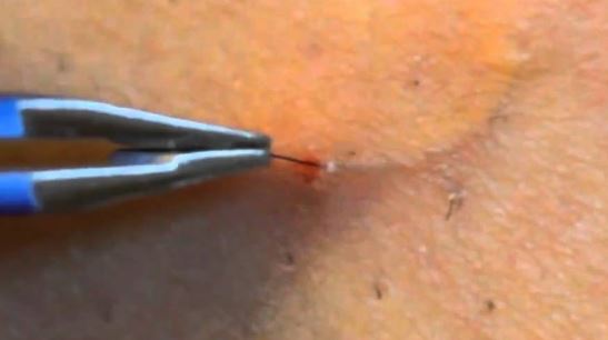How To Get Rid Of Ingrown Pubic Hair Pictures And Treatment