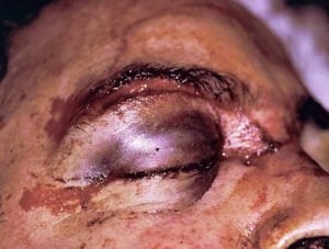 periorbital ecchymosis due to trauma