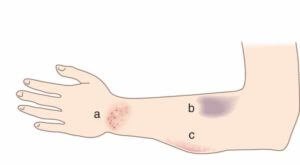 petechiae vs ecchymosis vs hematoma