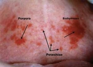 purpura vs petechia vs ecchymosis