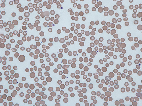 A severe type of anisocytosis
